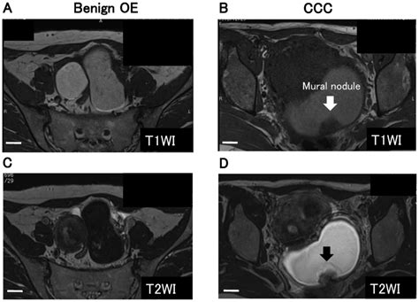 malignant transformation of endometriosis